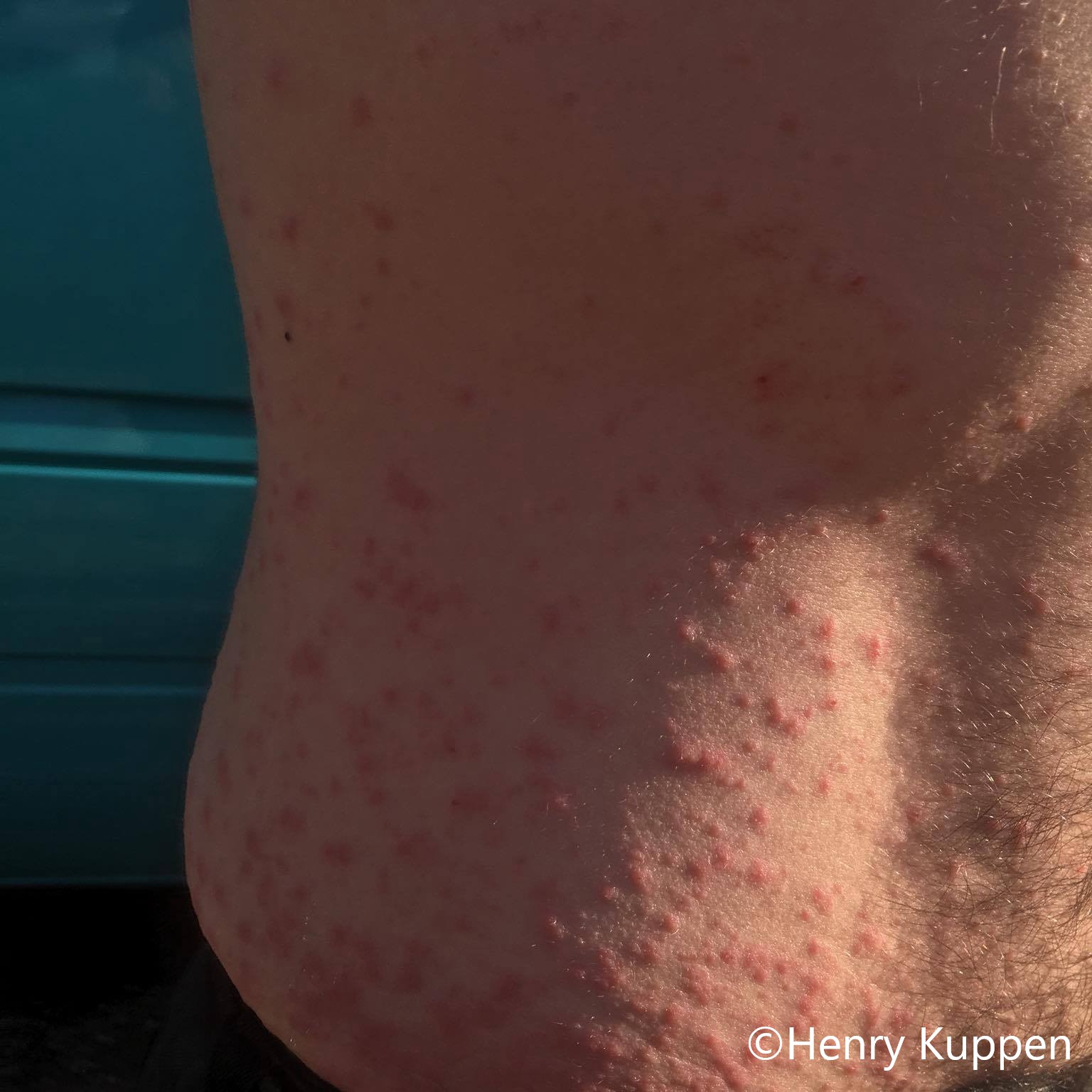Hawk Moth Rash Oak Processionary Moth Treatment risks to human and animal health